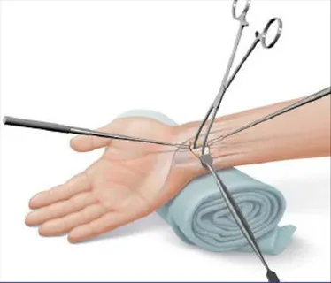 Life After Carpal Tunnel Surgery: Recovery Timeline and Success Rates