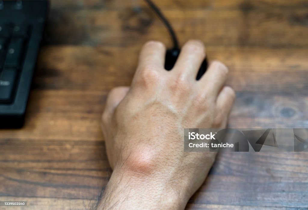 Non-Surgical Options for Managing a Ganglion Cyst